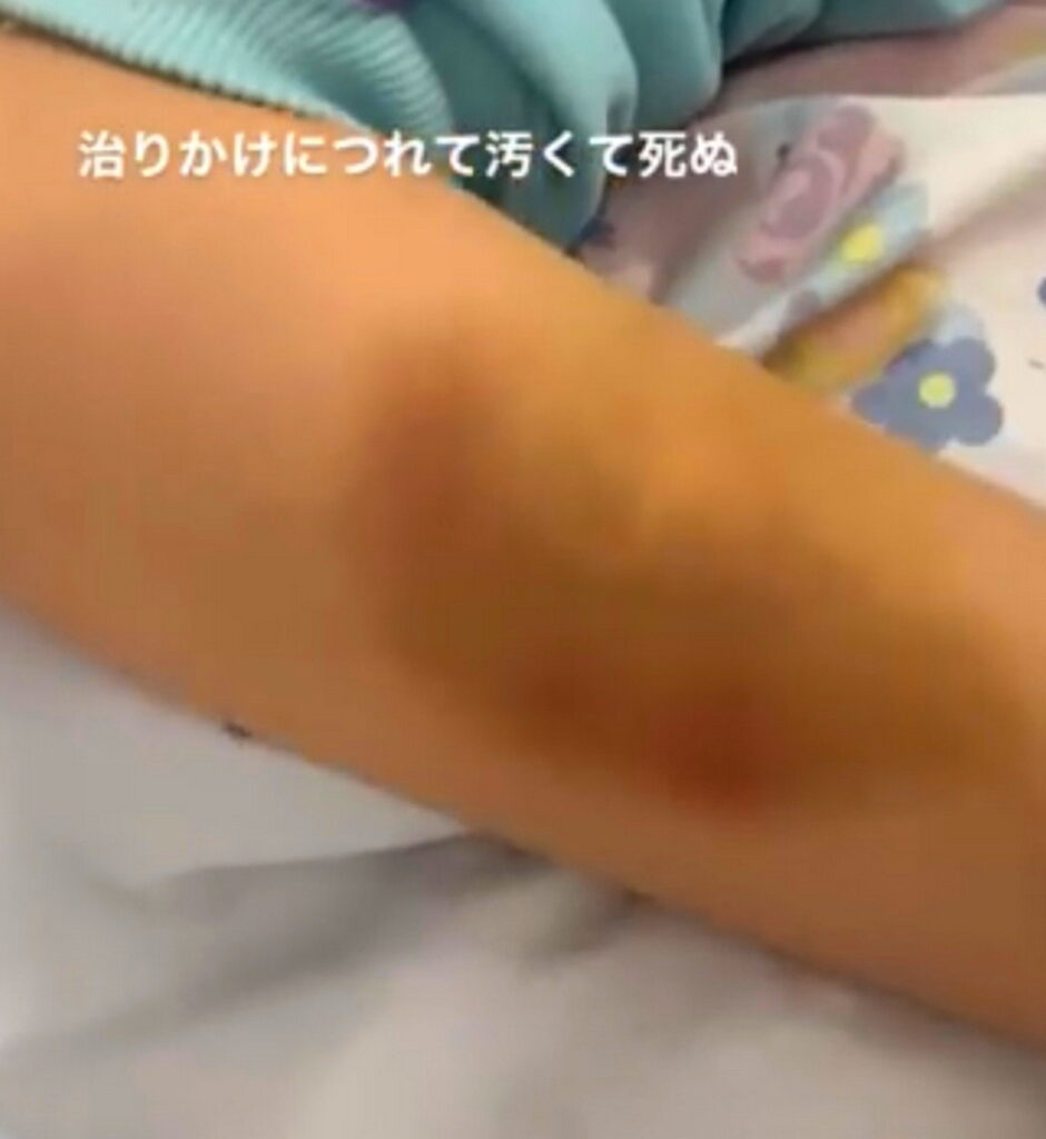 茉白カグヤ 妊娠直後のDVの痣 X